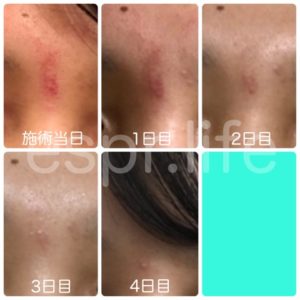 眉間のダウンタイム